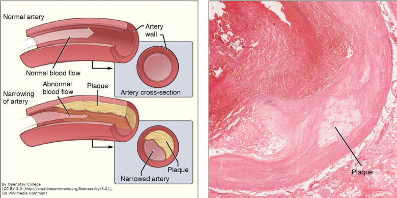 atherosclerotic-plaque-bioserendipity