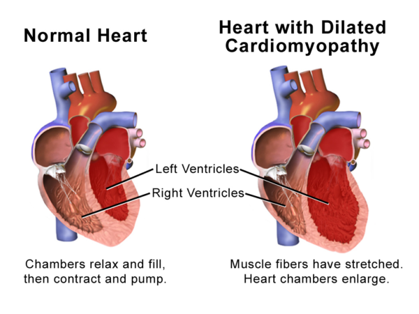 Dilated Cardiomyopathy | BioSerendipity