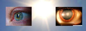 Eye_sun_cataract