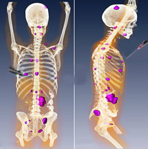 local_tumor_treatment